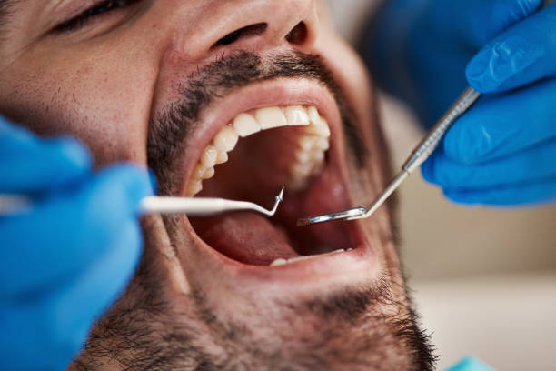 Best Emergency Dental Extractions in Lafayette, TN