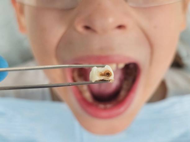 Best Emergency Dentist for Lost Fillings or Crowns in Lafayette, TN